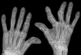 X-ray of rheumatoid arthritis affected hands